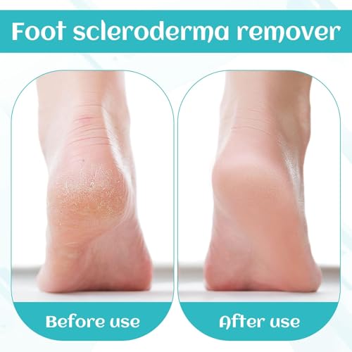 Professional Foot File Callus Remover Set, Stainless Steel Pedicure Tool with Storage Case, 10 Replacement Blades, Hard Skin Shaver for Feet Care