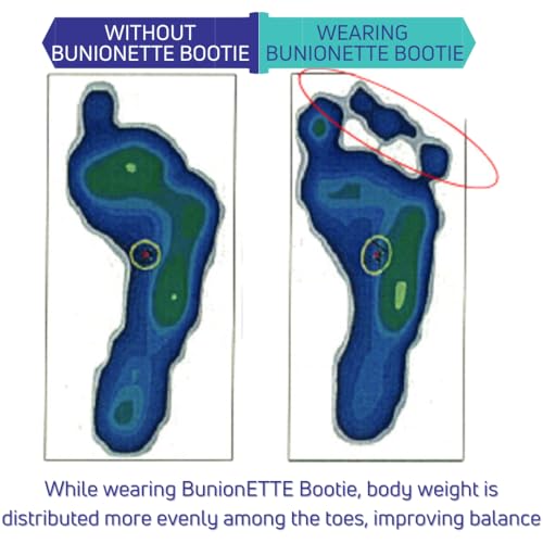 Tailors Bunion Corrector, Bunionette Relief Pinky Toe Sleeve. Med, Left Medium (Pack of 1)