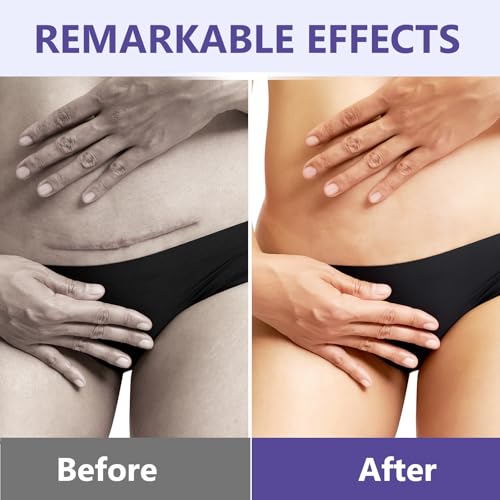 Keloid Bump Removal, Silicone Gel Hydrating Cream for Skin Bumps and Marks