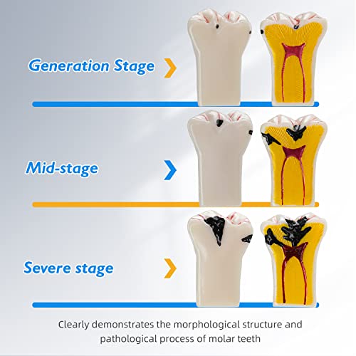 Dental Caries Teeth Model - 4 Times Removable Dental Tooth Decay Model Dental Caries Evolution Model Tooth Pathology Display Model