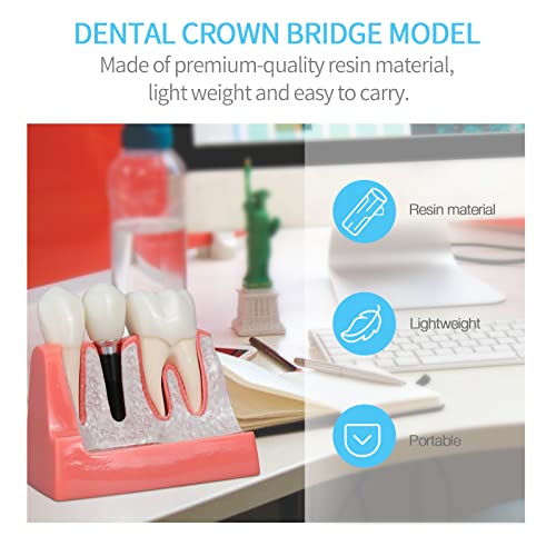 ANNWAN Dental Implant Model 4 Times Removable Analysis Crown Bridge Demonstration Teeth Model for Class Education and Studying Teeth Model