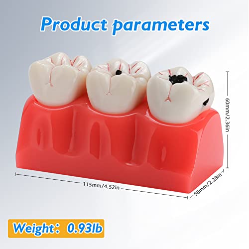 Dental Caries Teeth Model - 4 Times Removable Dental Tooth Decay Model Dental Caries Evolution Model Tooth Pathology Display Model