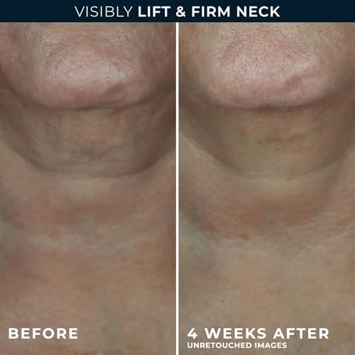 RoC Derm Correxion Neck Cream, Retinol + Hyaluronic Acid, Firming, 1.7 oz