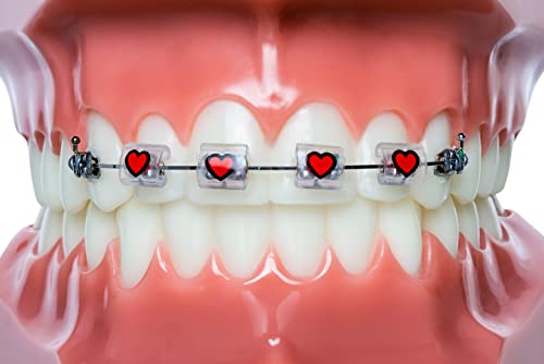 Braces Bumper Cover, Orthodontic Bracket Wax Substitute, Alternative Snap-on Braces Guard Braces Accessories 10 pack (Hearts) Hearts