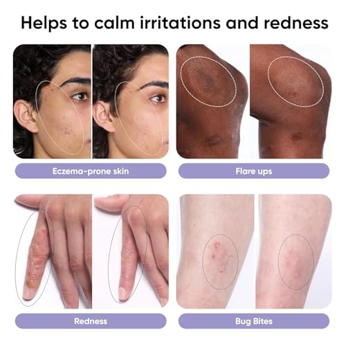 Itch Relief Spray, Hypochlorous Acid, Alcohol-Free, Steroid-Free, 3.4oz