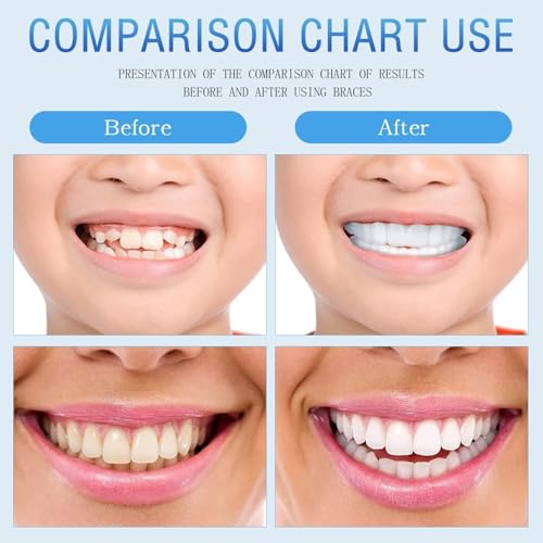 2 Pairs Lightweight Reusable Pre-Shaped Sets for Daily Smile Aesthetic Upgrade (Natural White) Natural White