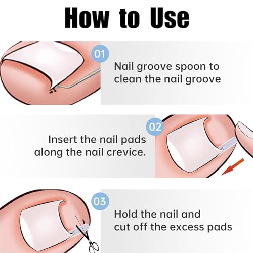 50 Pcs Ingrown Toenail Corrector Set, Toenail Correction Strips Brace Kit, Ingrown Toenails Correction Pad Recover Clips, Toenails Straightener Strips for Women Men's Nail Treatment Pedicure