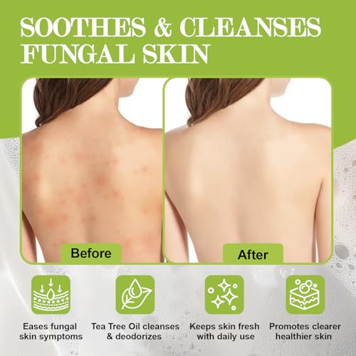 Antifungal Soap-Antibacterial Soap Bar with Tea Tree Oil- Body & Face Wash for Acne, Folliculitis, Eczema, Body Odor, Jock Itch, Athletes Foot, Tinea Versicolor (3Bars Original Tea Tree x 2.82 oz)