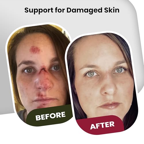Brave Soldier Antiseptic Healing Ointment - Best Wound Care & Skin Repair Cream with Tea Tree Oil - First Aid Supplies for Burns, Wounds & More, 1 Ounce