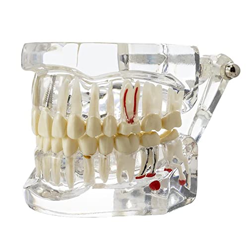 Dental Oral Typodont Model Implant Pathological Removable Teach Demo Visible Anatomy Demonstration Teaching Standard Size (Clear)