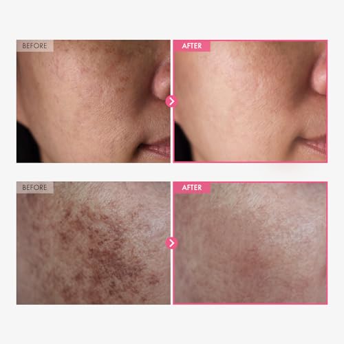 TOSOWOONG Arbutin 7% + Tranexamic Acid 4% Cream for Dark Spots, Brightening 1.69 Fl Oz (Pack of 1)
