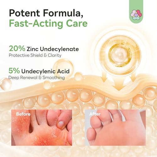 SAVILAND Antifungal Cream Athlete's Foot Jock Itch Ringworm Treatment 4.2oz