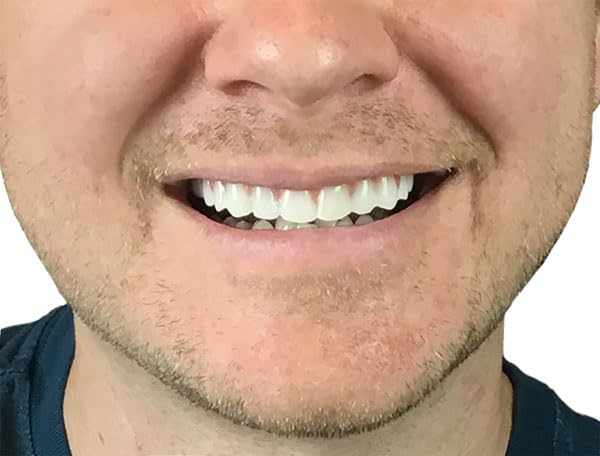 Instant Smile Comfort Fit Flex Cosmetic Teeth, Natural Shade, Upper 1 Count (Pack of 1)