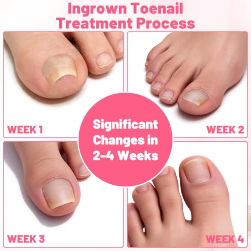 Ingrown Toenail Removal Kit Professional Ingrown Toenail Tool Kit with Ingrown Toenail Corrector, Corrector Patches, Toenail Clipper, Tools Stainless Steel Pedicure Tool Set