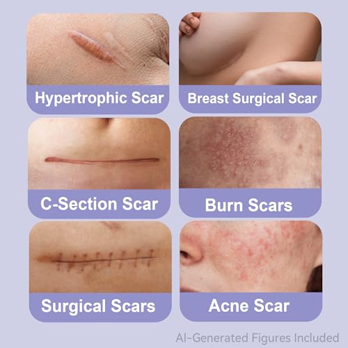 Ourmed Silicone Scar Removal Sheets (1.6" x 6", Pack of 5) Medical Grade Silicone Scar Removal Sheets, Hypoallergenic for New and Old Scars – Surgery, Burns, Acne, Keloids, Stretch Marks, C-Section 1.6"x 6" (5 Pcs)