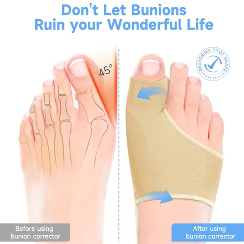2PCS Bunion Corrector for Women & Men Big Toe, Bunion Splint with Spacers (1, Beige) 1