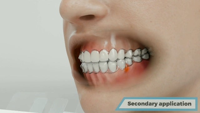 Comfort Tape, Instant Comfort and Relief for Oral Pain Caused by Braces, Aligners, Dentures and Dental Appliances, Up to 2 Hours of Relief for Orthodontic Pain
