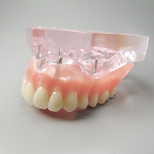Dental Model Overdenture Upper Teeth 4 Implants Demo for Teaching and Studying