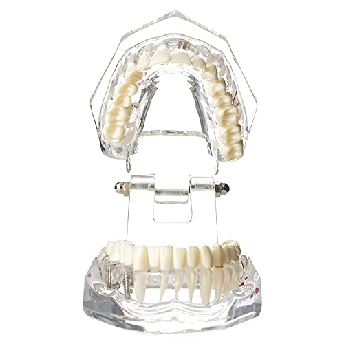 Dental Oral Typodont Model Implant Pathological Removable Teach Demo Visible Anatomy Demonstration Teaching Standard Size (Clear)