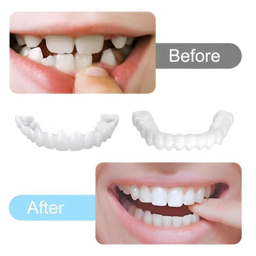 2 Pairs of Smile Adjustable Supports Unisex for Temporary Use to Quickly Restore Self-Confident Smiles