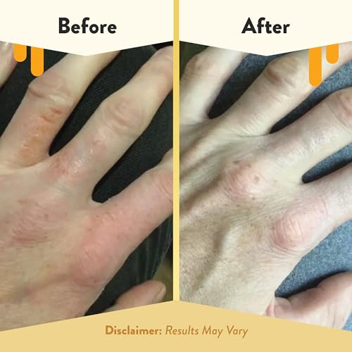 ECZEMA HONEY Oatmeal Hand Cream, for Dry, Itchy, Sensitive Skin (2 Oz) 2 Ounce (Pack of 1)