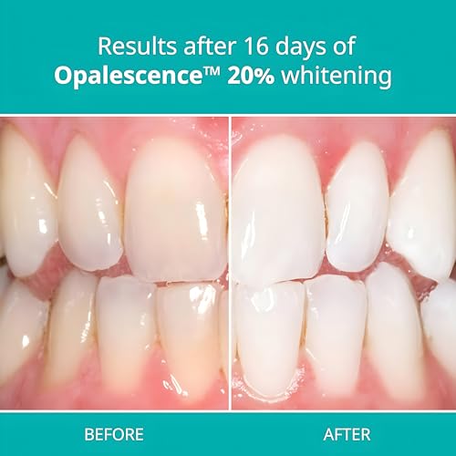Opalescence 20% Teeth Whitening Gel Refill Syringes, with PF (8ct) 5402-4