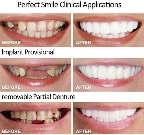 Adjustable for Men and Women,Fix Your Smile at Home Within Minutes(2pairs) (2)