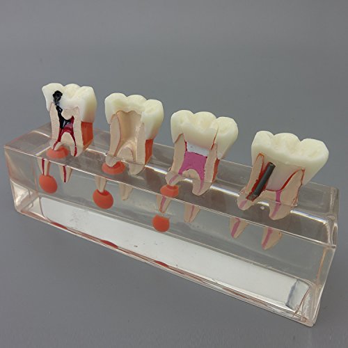 Dental Teeth Model 4-Stage Endodontic Treatment Model for Studying and Teaching …