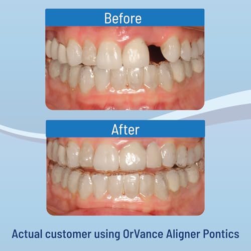 ORVANCE Aligner Pontics Temporary Tooth Replacement - Medium 1pk (16ct) 16 Count (Pack of 1) Medium Shade