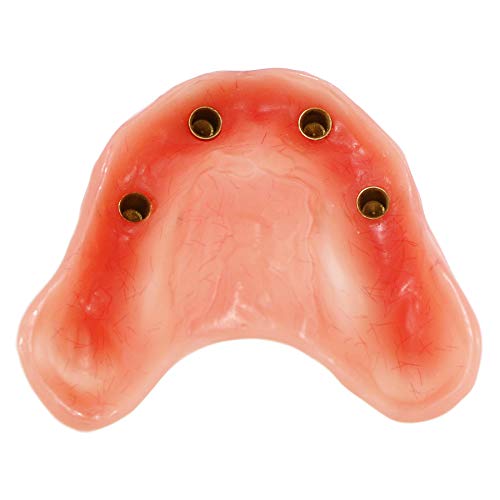 Dental Implant Teeth Demo Model Maxillary Overdenture with 4 Implants