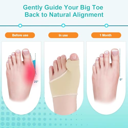 2 Pairs Bunion Corrector Relief Sleeve,Big Toe Straightener with Gel Pads,Orthopedic Hallux Valgus Brace for Toe Alignment,Pain Relief Cushion for Daily Wea(Grey,S)