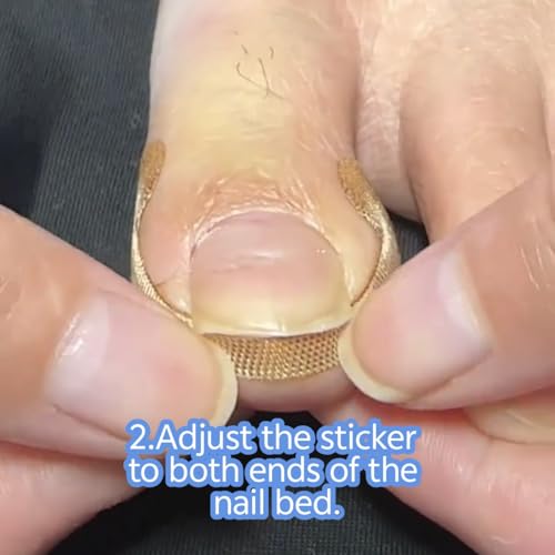 Ingrown Toenail Corrector Kit - Professional Painless Correction Strips & Pedicure Tools for At-Home Care