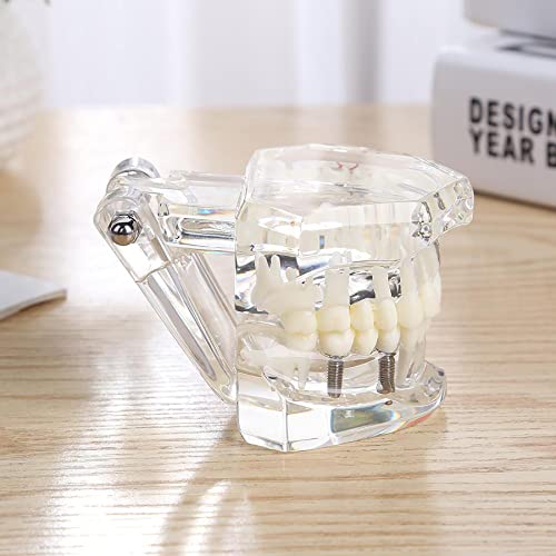 Dental Oral Typodont Model Implant Pathological Removable Teach Demo Visible Anatomy Demonstration Teaching Standard Size (Clear)