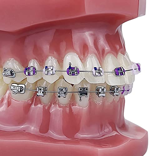 Orthodontic Model, YOUYA DENTAL 1/4 Metal self-Locking Comparison Orthodontic Model Orthodontic Tooth Model Dental Teaching Teeth Model with Metal Braces Bracket for Dentist Teaching Tools to Display 1/4 Metal self-Locking Model