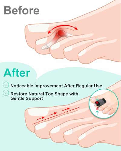2Pcs Hammer Toe Straightener Broken Toe Splint with Removable Aluminum Plate and 2Pcs Fabric Wraps for Women & Men, Adjustable HammerToe Corrector for Curled & Bent Toe, Broken Support (Large) Large