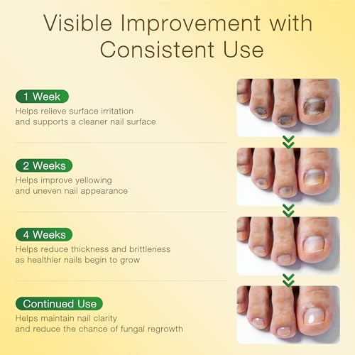 Toenail Fungus Treatment Extra Strength - with 25% Undecylenic Acid - SafeFight Nail Repair Solution for Damaged Nails, Ingrown Nails & Discoloration, 30ML 1 Pack 30ML(1 Pack)