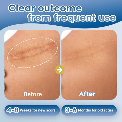 Advanced Silicone Scar Gel for Face & Body – Silicone Scar Cream for Old & New Scars, Reduces Appearance of Scars from Acne, Surgery, Burns, Injuries, C-Sections & More – 3.53 oz (100g) 3.53 Ounce