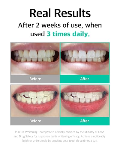 Live Orals Pure Dia Teeth Whitening Gel Kit and PureDia Whitening Toothpaste 80g