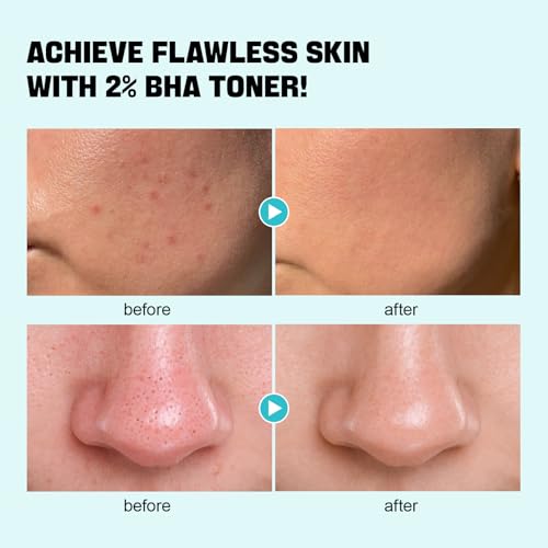 ZealSea Salicylic Acid Toner, Blackhead Remover, Pore Minimizer Oil Control BHA 6.76 FL.OZ.(Pack of 1)