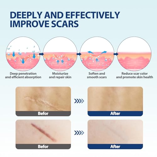 Boysea Scar Cream & Serum Oil, Advanced Scar Removal Set, Reduces Appearance of Keloids, C-Sections, Surgeries, Burns, Acne, 2 x 1.06 Oz Bottles
