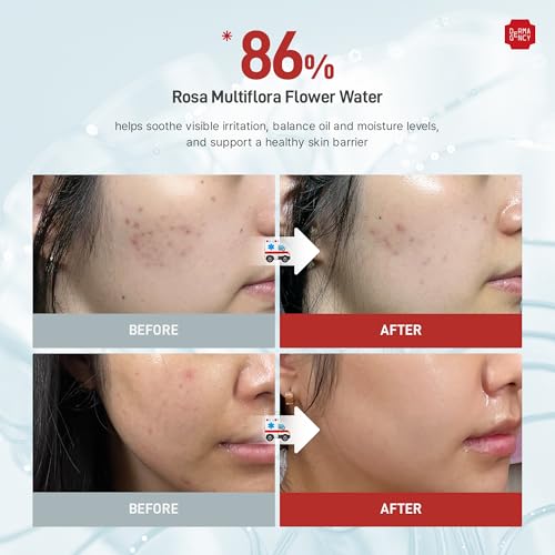 Zeroca 86 Toner | Korean Toner for Acne-Prone & Sensitive Skin | Lightweight, Fast-Absorbing | Oil Control, Pore Refining, Redness Relief | Fragrance-Free | K-Beauty 6.76 Fl.Oz 200ml