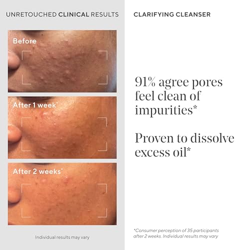 Murad Acne Control Clarifying Cleanser - Salicylic Acid 5 Fl Oz (Pack of 1)