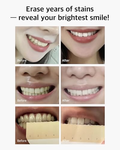 Live Orals Pure Dia Teeth Whitening Gel Kit and PureDia Whitening Toothpaste 80g