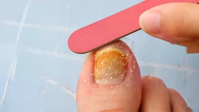 Nail Fungus Pen : Toenail Fungus Treatment Extra Strength - Antifungal Nail Repair for Damaged, Yellow, Thick Toenails - 25% Undecylenic Acid & Tea Tree Oil Mild and Non-Irritating 3pieces