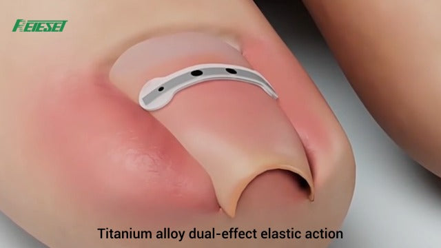 Titanium Alloy Ingrown Toenail Treatment, NailTools, and Ingrown Toenail Removal Kit SpeciallyDesigned for Curved Nail Repair and Ingrown ToenailCorrector (0.59/0.67in) 0.59/0.67in