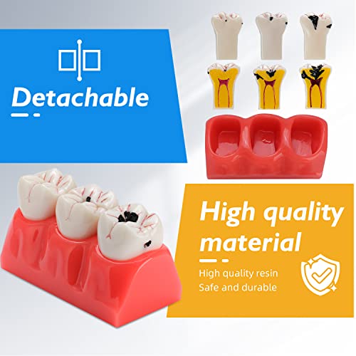 Dental Caries Teeth Model - 4 Times Removable Dental Tooth Decay Model Dental Caries Evolution Model Tooth Pathology Display Model