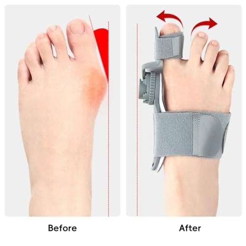 Leadigol Thumb Abduction Orthotic with Adjustable Knob,Rotatable Toe Separator Straightener Pedicure Foot Correction Brace(Grey)