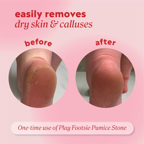 Onyx Professional Double Sided Pumice Stone, 2 Pack - 100% Siliglass Callus Remover for Feet, Elbows, Knees, Dead Skin, Heels, Hands, Foot File Scrubber Exfoliator, Pumice Stone for Feet 1 Count (Pack of 2)