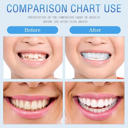 2 Pairs Beginner-Friendly Smile Tuning Kit, Tool-Free Shaping, Unisex Reusable Universal Daily Pack (Bright White) Bright White