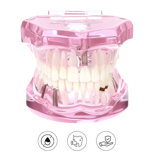 QWORK Dental Implant Teeth Model #2001 Typodont Restoration Pink – Detailed Fixed Prosthetic Study Aid for Dental School Education, Patient Consultation & Training